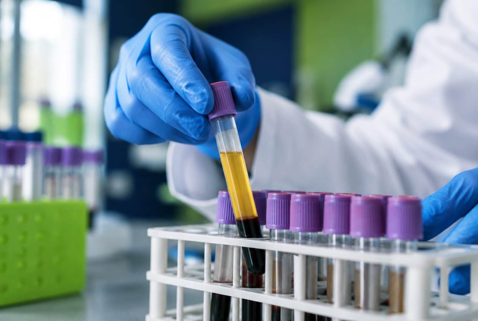Biohemijske analize - Humalab laboratorija Subotica