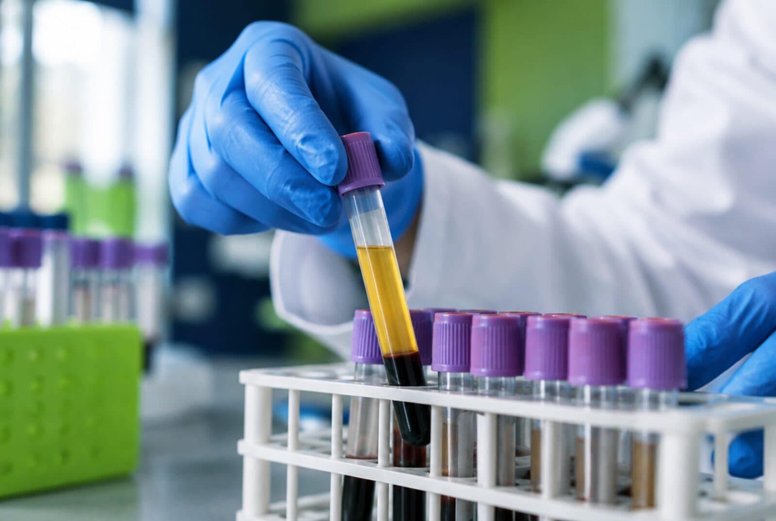 Laborant u rukavicama stavlja epruvetu sa serumom u stalak - biohemijske analize u Humalab laboratoriji