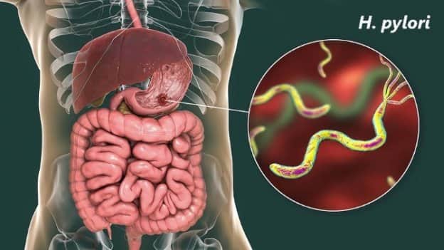 Helicobacter pylori - Simptomi i dijagnostika