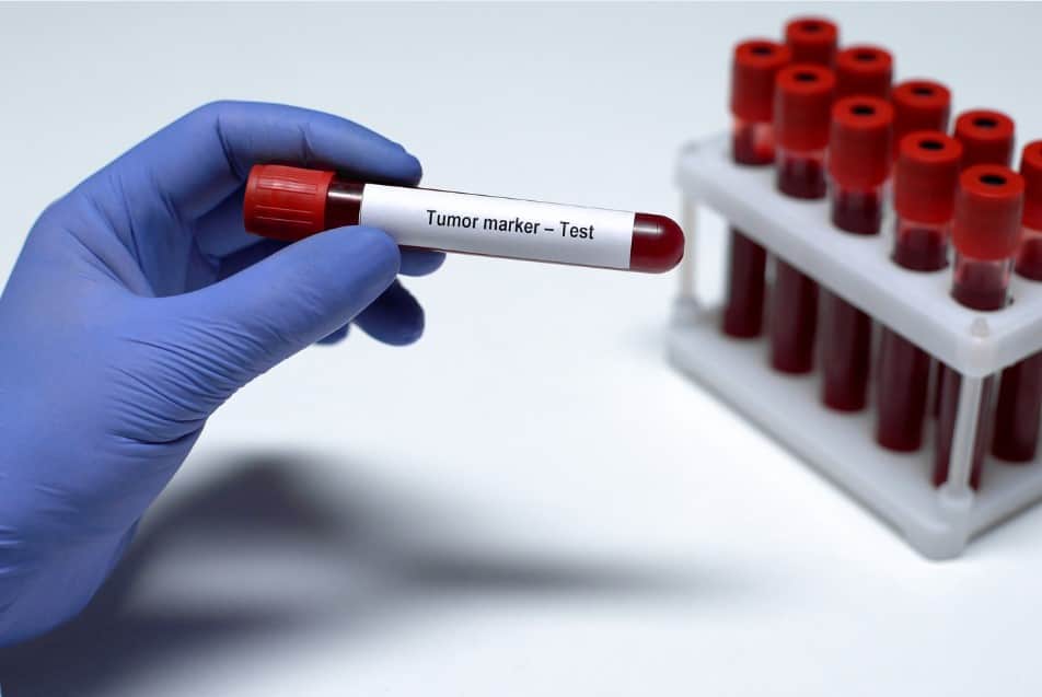 Hormoni i tumorski markeri - Humalab laboratorija Subotica