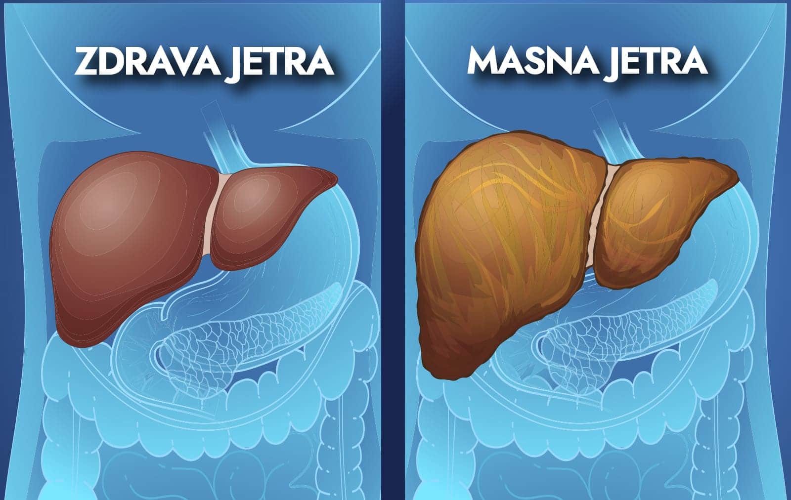 masna jetra, ciroza jetre