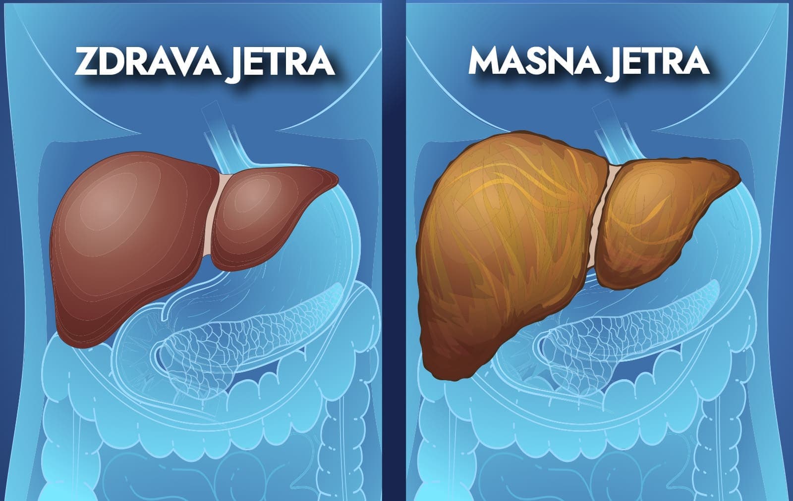 masna jetra, ciroza jetre